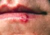 Herpes Labial: um problema recorrente? Herpes Labial