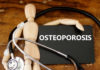 Osteoporose: uma doença perigosamente silenciosa osteoporose
