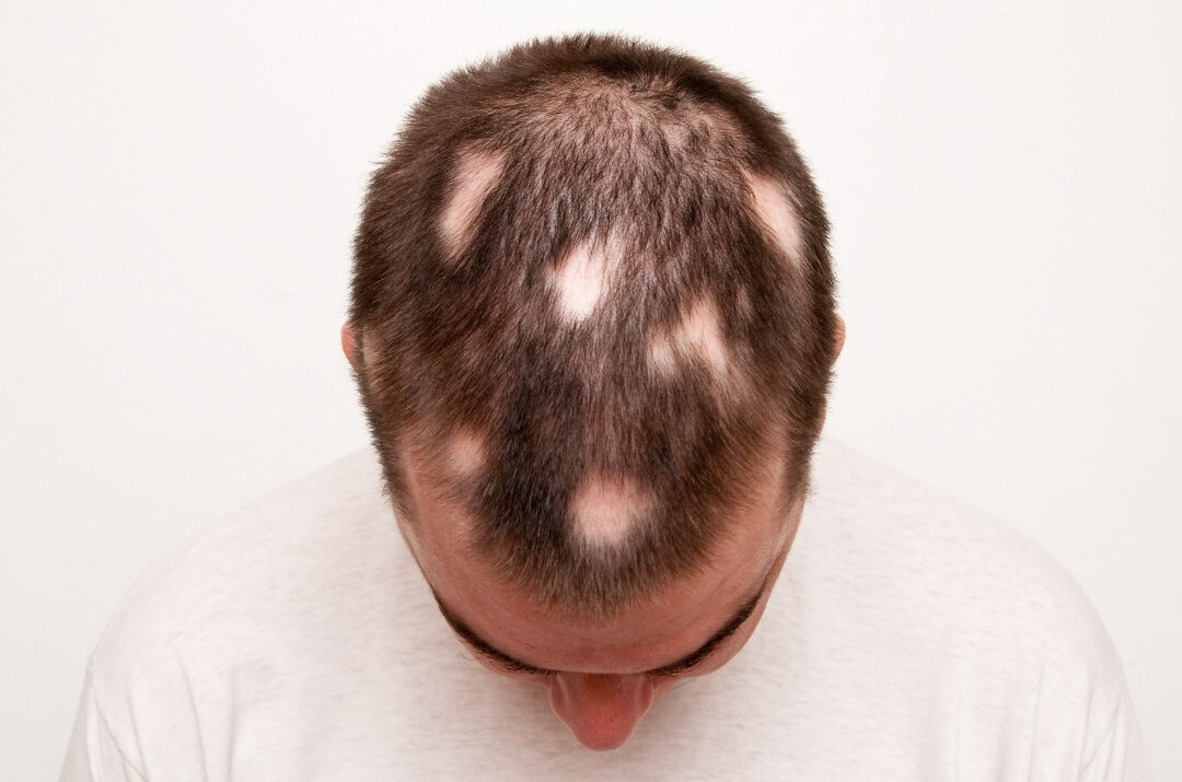 calvície alopecia minoxidil oral