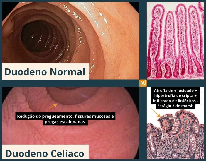 imagem comparando duodeno normal e duodeno com doença celíaca