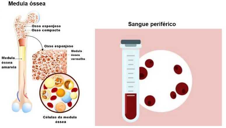 transplante