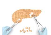 Evidência clínica inédita de Transplante de Ilhotas sem imunossupressão no DM1 vacina contra cancer de pancreas Evidência clínica inédita de Transplante de Ilhotas sem imunossupressão no DM1