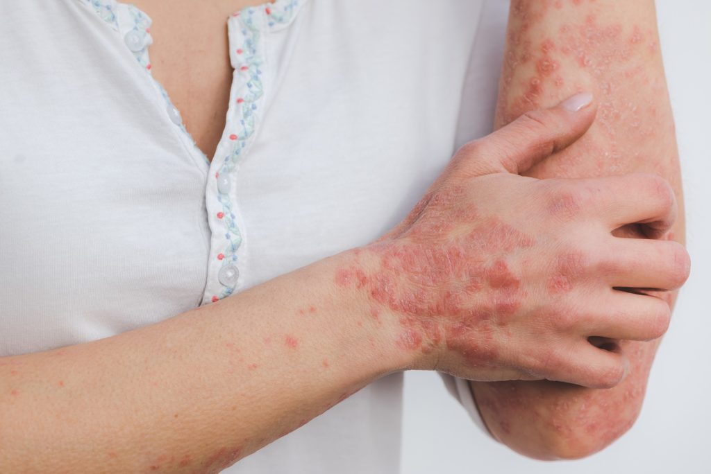 braços de paciente com artrite psoriásica, uma possível indicação para avaliação de HLA-B27
