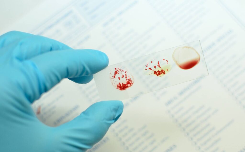 amostra de sangue aglutinada