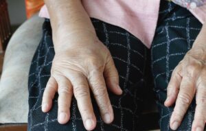 critérios para esclerodermia mão inchada