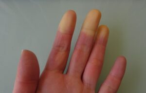 raynaud critérios para esclerodermia eular acr esclerose múltipla