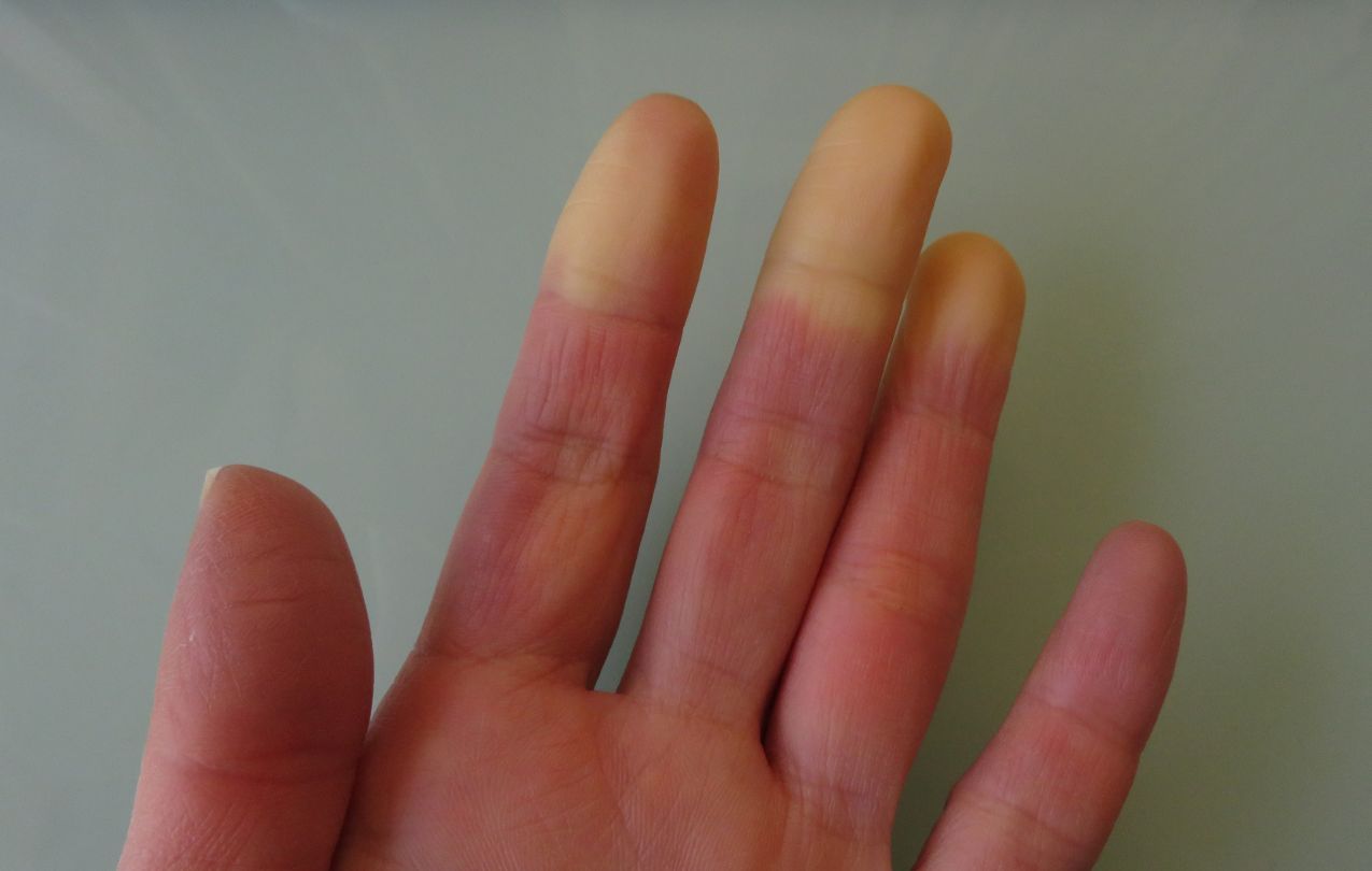 raynaud 