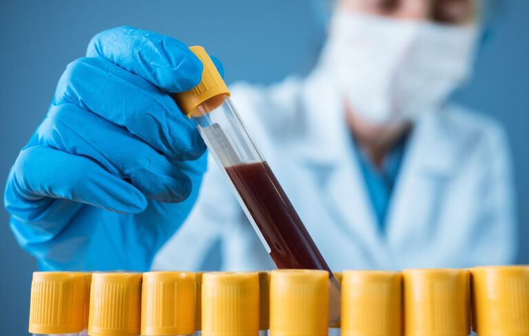 Alfafetoproteína como marcador em Carcinoma Hepatocelular | Portal WeMEDS