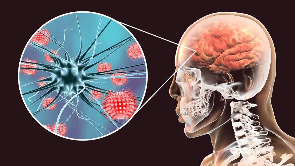 imagem representando cérebro com zoom em células neurais com meningite viral