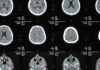 Meningite: diagnóstico, interpretação do líquor e manejo inicial exame neurológico para identificação e diagnóstico de meningite