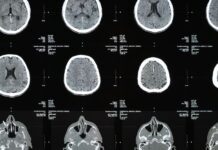 Meningite: diagnóstico, interpretação do líquor e manejo inicial exame neurológico para identificação e diagnóstico de meningite