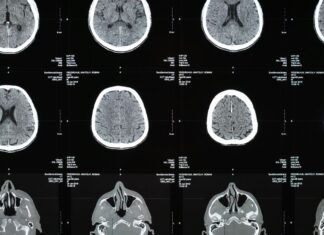 Meningite: diagnóstico, interpretação do líquor e manejo inicial exame neurológico para identificação e diagnóstico de meningite