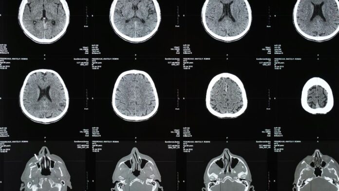 exame neurologico exame neurológico para identificação e diagnóstico de meningite