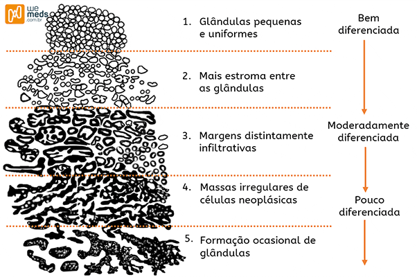 Escore de Gleason no prognóstico do Câncer de Próstata