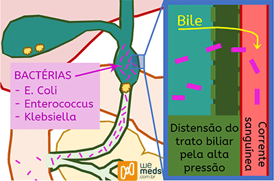 colangite aguda