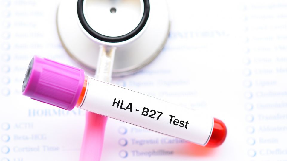 tubo de sangue coletado para realização de exame de HLA-B27 nas espondiloartropatias