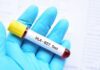 HLA-B27: interpretação clínica e papel atual no diagnóstico das espondiloartrites tubo de sangue coletado para realização de exame de HLA-B27 nas espondiloartropatias