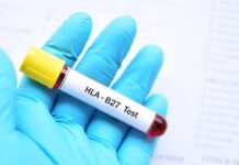 HLA-B27: interpretação clínica e papel atual no diagnóstico das espondiloartrites tubo de sangue coletado para realização de exame de HLA-B27 nas espondiloartropatias