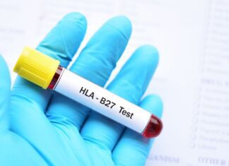HLA-B27: interpretação clínica e papel atual no diagnóstico das espondiloartrites tubo de sangue coletado para realização de exame de HLA-B27 nas espondiloartropatias
