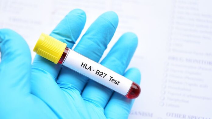 tubo de sangue coletado para realização de exame de HLA-B27 nas espondiloartropatias
