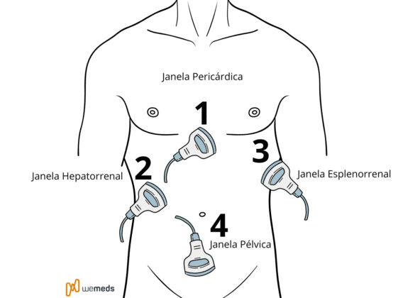 Fast Traumar Saiba como usar o Protocolo FAST (Focused Assessment With Sonography ...