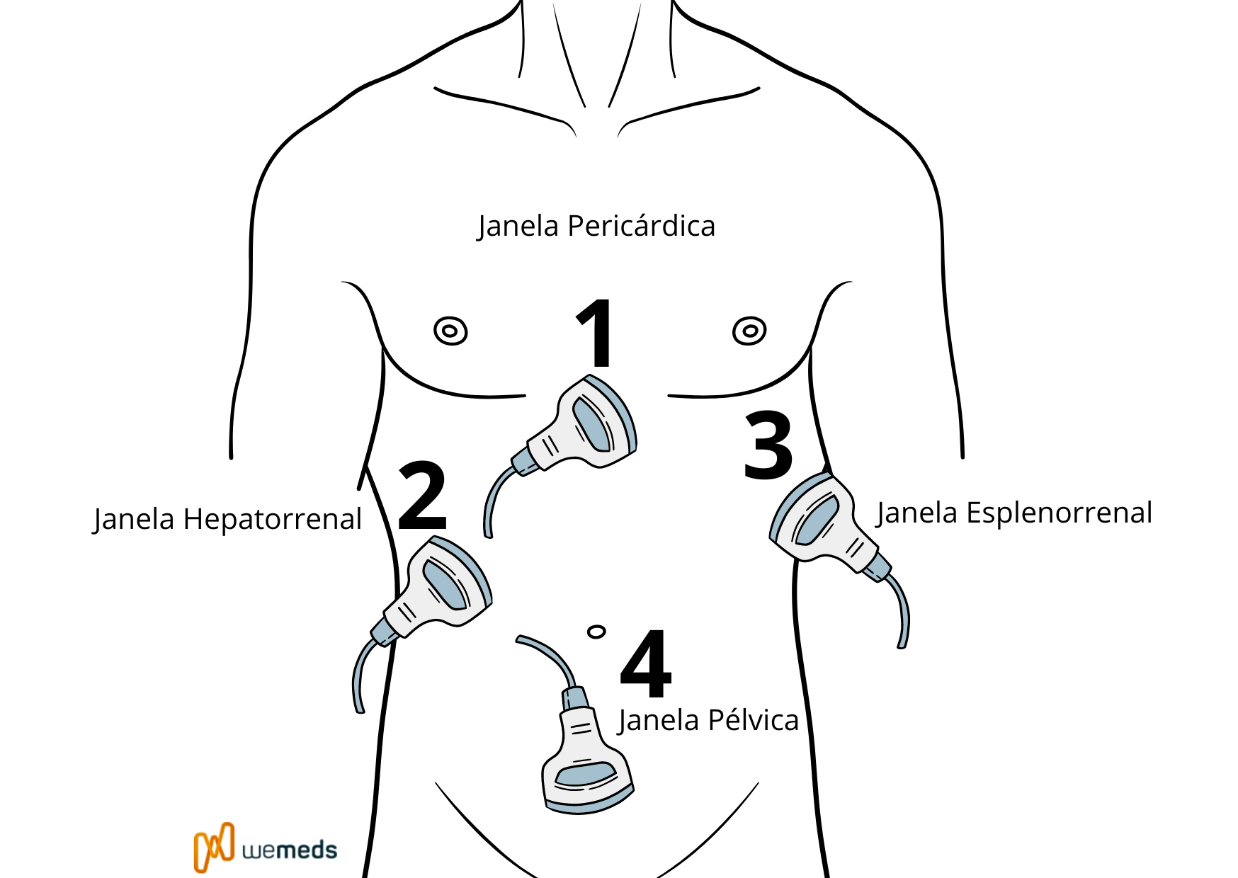 Protocolo FAST (Focused Assessment With Sonography for Trauma)