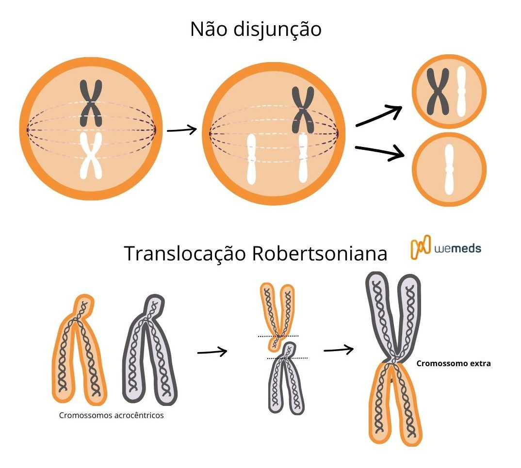 trissomia do cromossomo 13