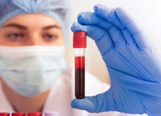 Exame VHS: velocidade de hemossedimentação, valores de referência e quando está alta Profissional de laboratório analisando um tubo de amostra de sangue, representando o exame de velocidade de hemossedimentação (VHS).