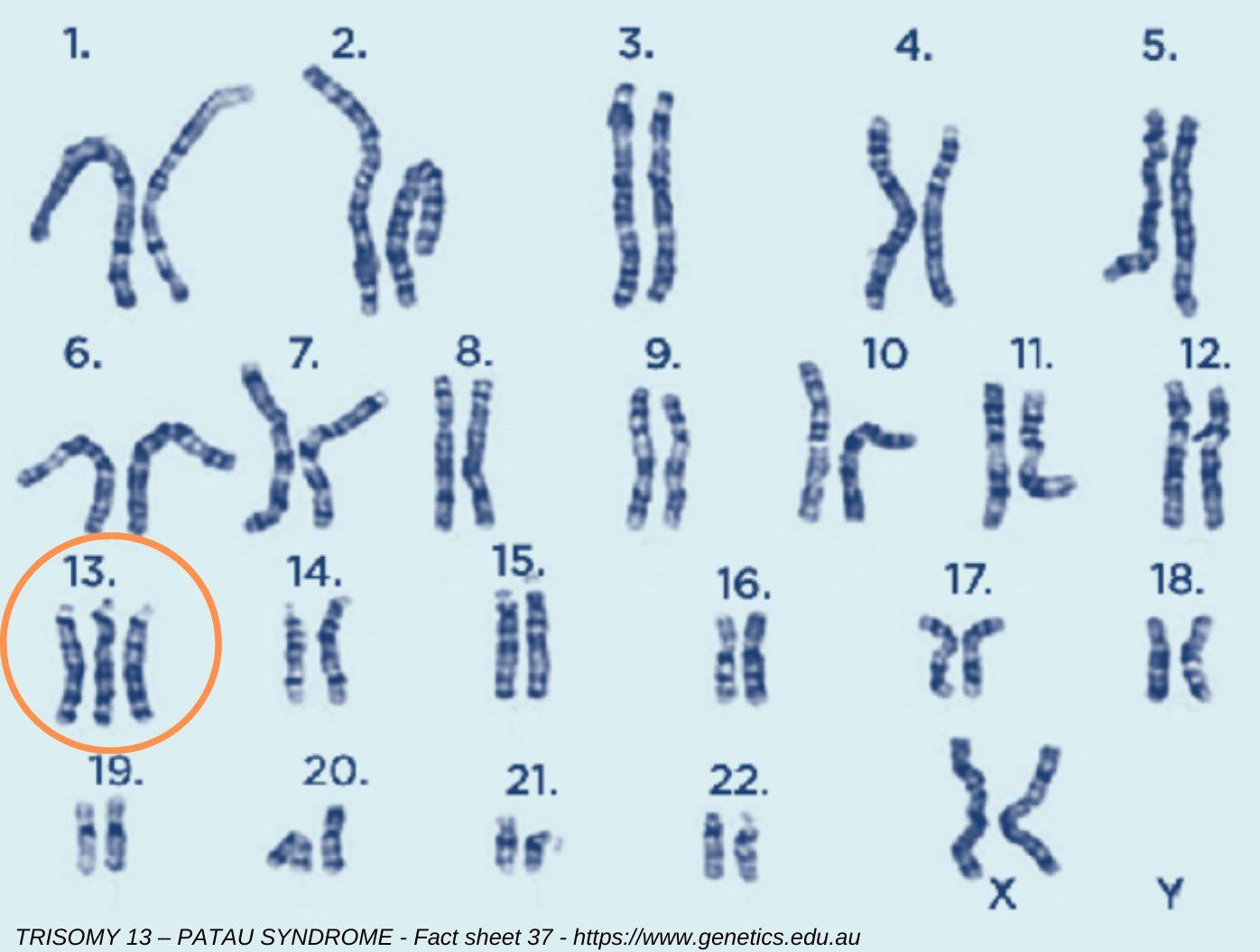 trissomia do 13