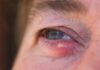 Hordéolo (terçol): o que todo médico deve saber