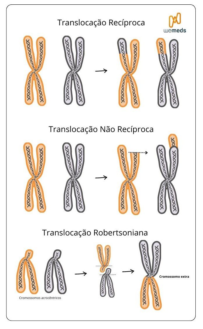 Síndrome de Down - translocação 