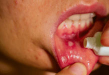 Síndrome de Behçet: o que mudou nas novas diretrizes de tratamento pomada para estomatite aftosa utilizada no tratamento da Síndrome de Behçet