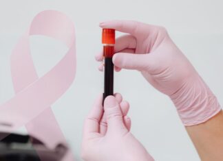 CA 15-3: indicações, limitações e interpretação no câncer de mama tubo de sangue coletado representando exame de CA 15-3 no câncer de mama