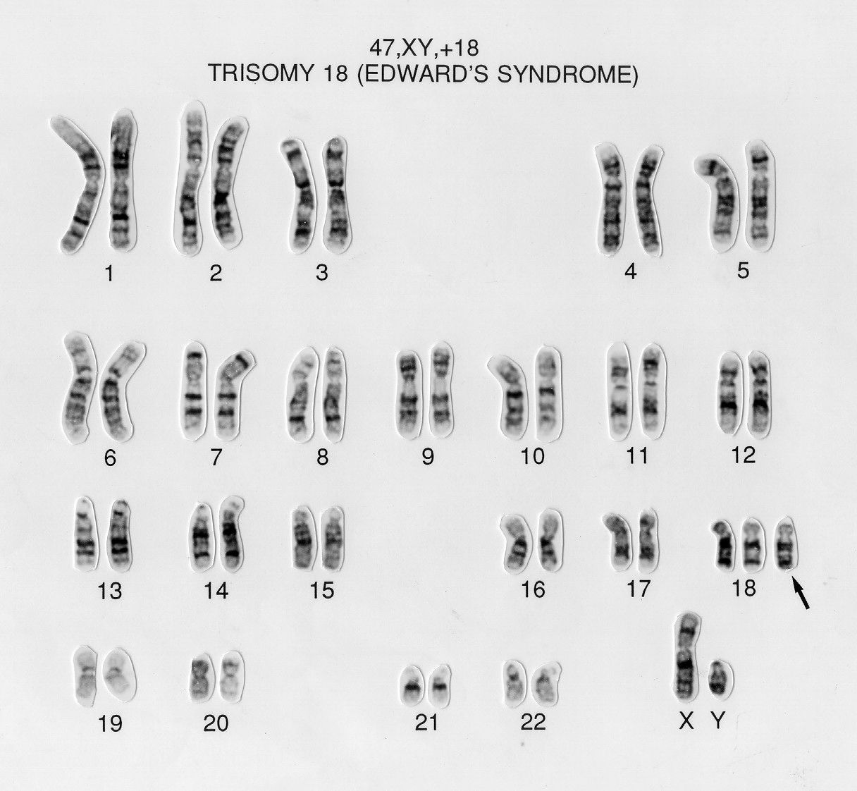 trissomia do 18 sindrome de edwards