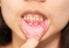 Estomatite aftosa recorrente: fatores de risco, diagnóstico e tratamento