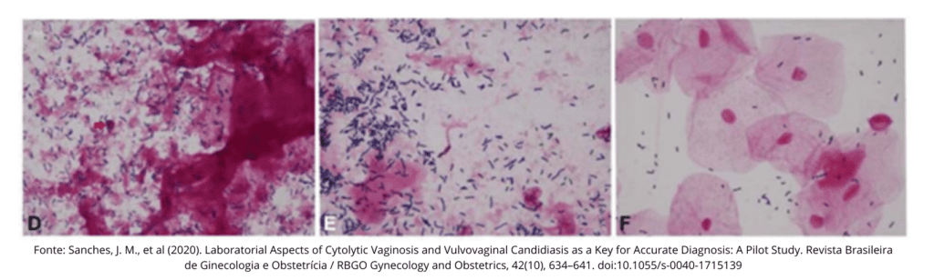 microscopia de vaginose citolítica