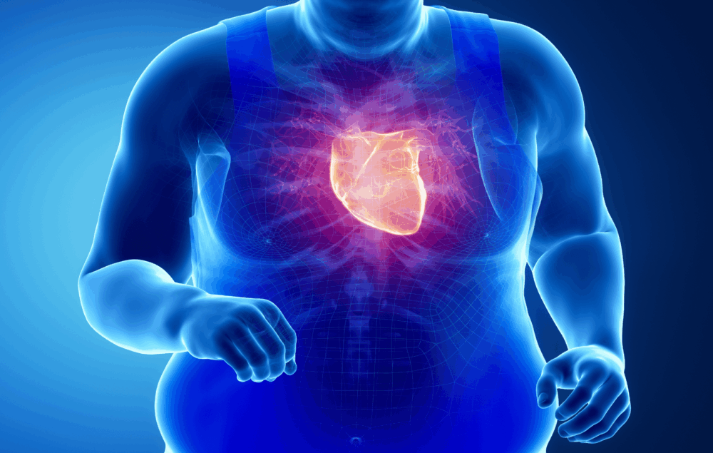 Síndrome CKM: o que muda com a nova diretriz de 2026? imagem de coração destacado em paciente obeso, representando a síndrome CKM (síndrome cardiovascular renal metabólica)