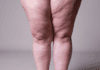 Lipedema: etiologia e fisiopatologia, diagnóstico e tratamento