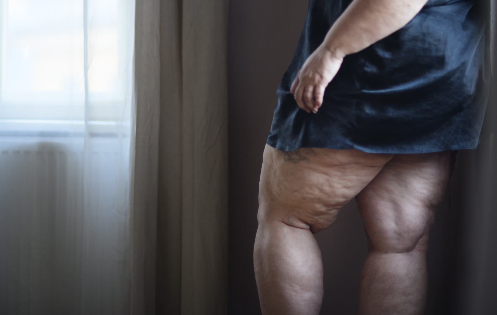 Lipedema: etiologia e fisiopatologia, diagnóstico e tratamento