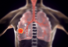Anvisa aprova Datroway® (datopotamabe deruxtecana) para câncer de pulmão EGFR-mutado imagem representando tórax com câncer de pulmão, que pode ser tratado com Datroway® (datopotamabe deruxtecana) segundo nova aprovação da Anvisa