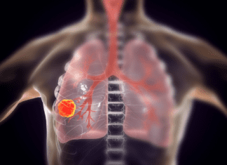 Anvisa aprova Datroway® (datopotamabe deruxtecana) para câncer de pulmão EGFR-mutado imagem representando tórax com câncer de pulmão, que pode ser tratado com Datroway® (datopotamabe deruxtecana) segundo nova aprovação da Anvisa