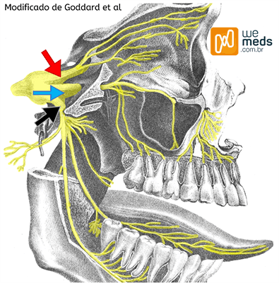 Neuralgia do trigêmeo