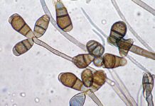 Feohifomicose por Curvularia: manifestações clínicas, diagnóstico e tratamento feohifomicose por curvularia