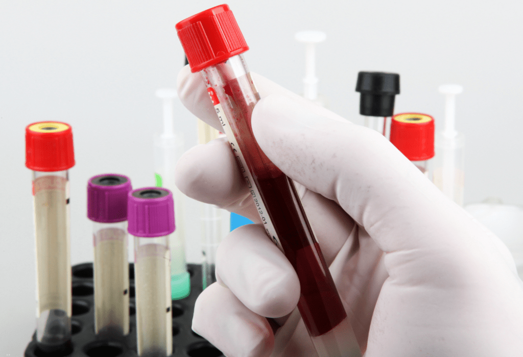 tubo de coleta de sangue para realização de exame investigando anemia hemolítica autoimune por anticorpos quentes
