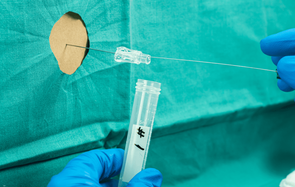 punção lombar realizada para coleta de liquido cefalorraquidiano (LCR) para diagnóstico de meningite