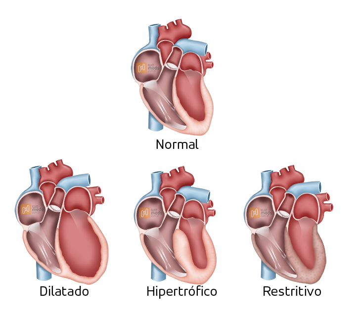 Diretriz sobre Diagnóstico e Tratamento da Cardiomiopatia Hipertrófica 