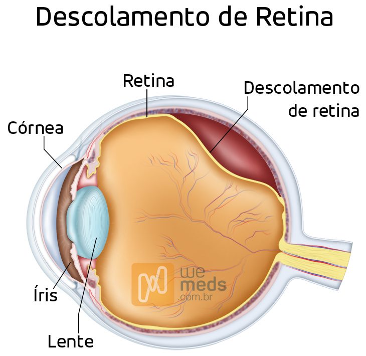 descolamento de retina