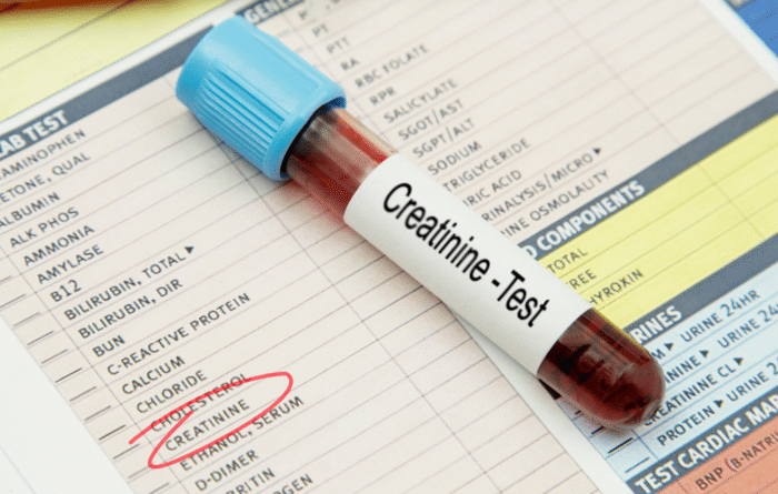 exame de creatinina, utilizado como parte dos critérios ICA-AKI para diagnóstico de Síndrome Hepatorrenal