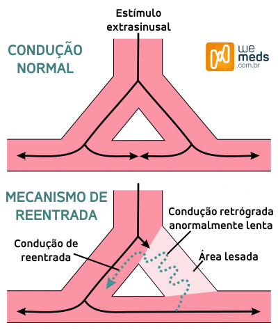 Síndrome do Coração Pós-Feriado fibrilação atrial