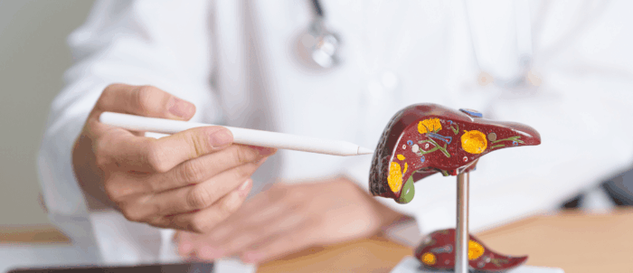 médico apontando para um fígado com potencial carcinoma hepatocelular 